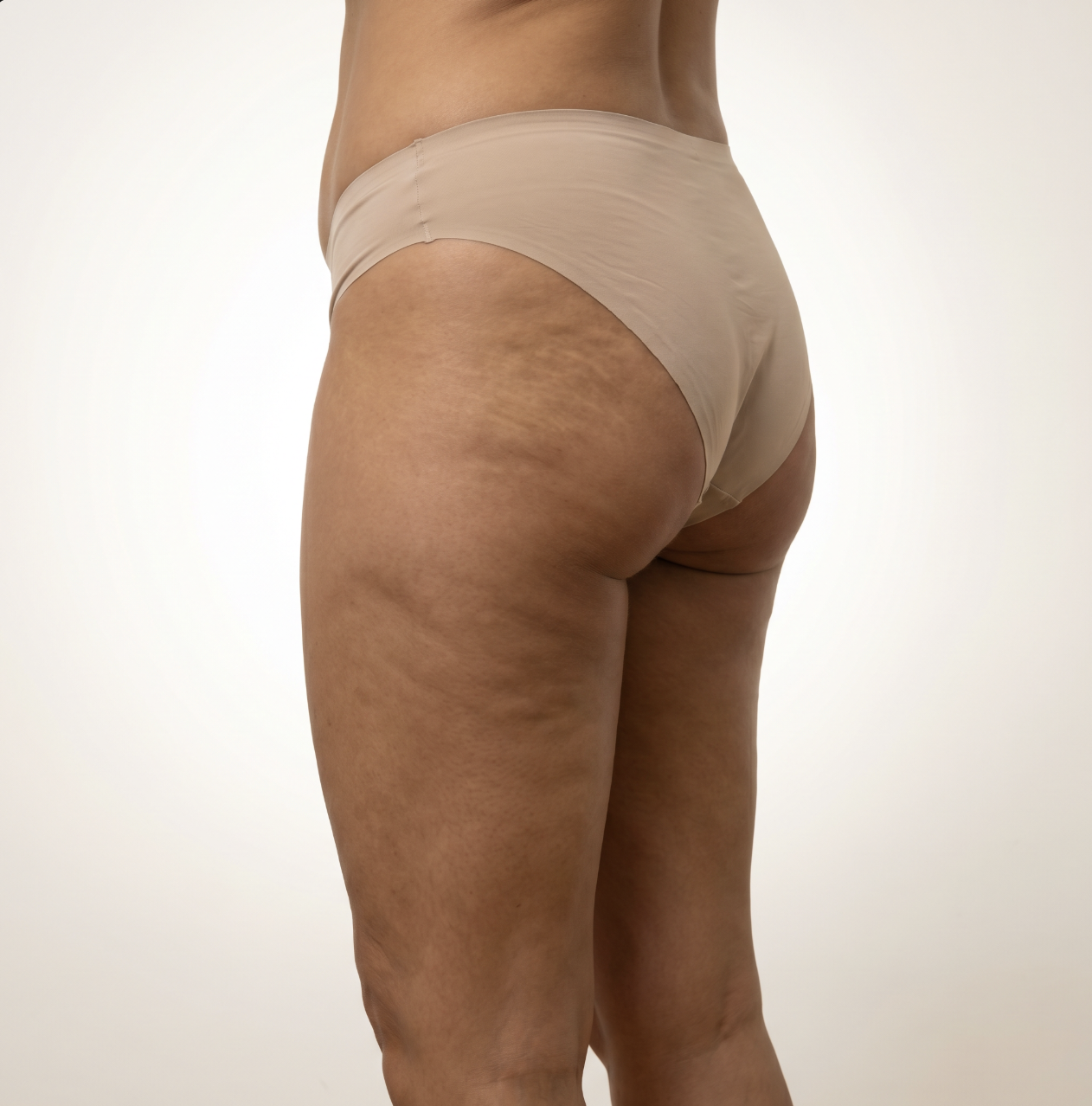 Mesoterapia Corporal